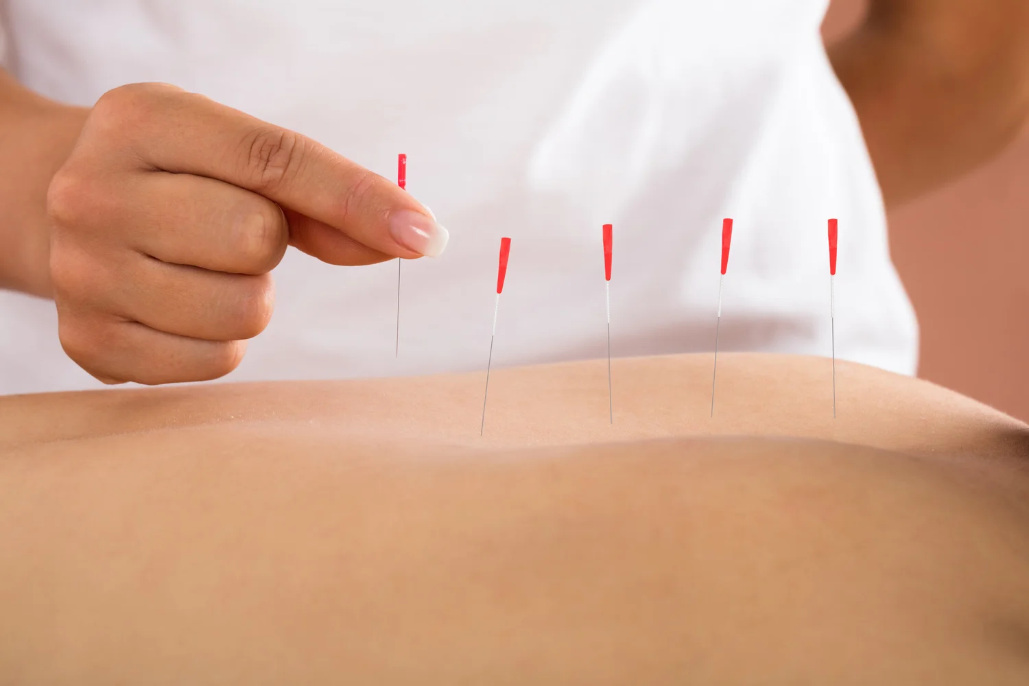 dry needling near me