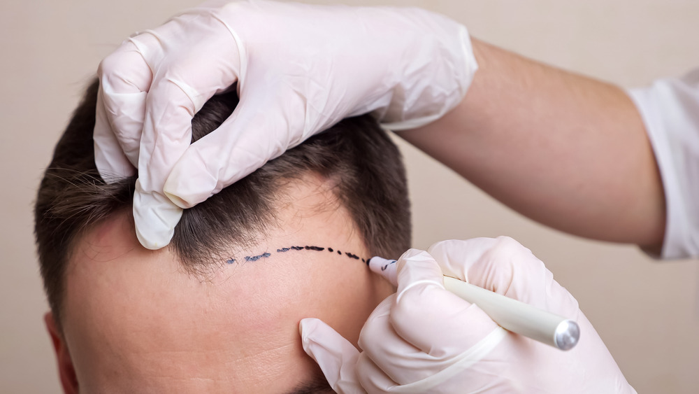 hair transplant cost London