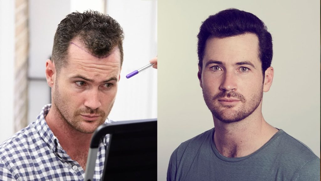Hair transplant birmingham