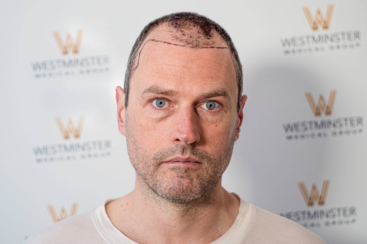 Hair transplant birmingham
